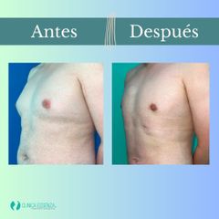 Ginecomastia - Clinica Essenza
