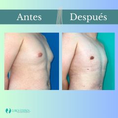 Ginecomastia - Clinica Essenza