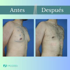 Ginecomastia - Clinica Essenza