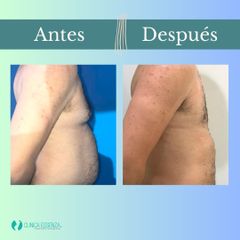 Ginecomastia - Clinica Essenza