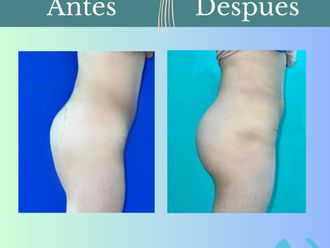 Aumento glúteos antes y después - 862045