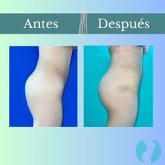 Aumento glúteos - Clinica Essenza