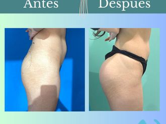 Aumento glúteos antes y después - 862046