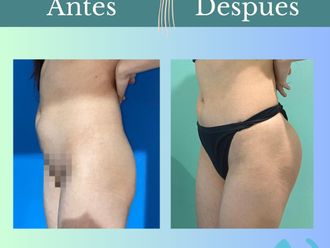 Aumento glúteos antes y después - 862047