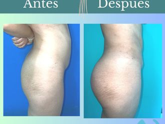 Aumento glúteos antes y después - 862048
