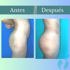 Aumento glúteos - Clinica Essenza