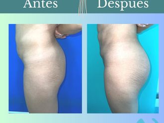 Aumento glúteos antes y después - 862049