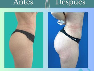 Aumento glúteos antes y después - 862050