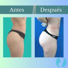 Aumento glúteos - Clinica Essenza