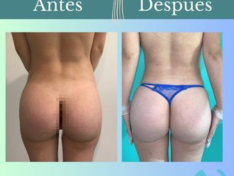 Aumento glúteos antes y después - 862051