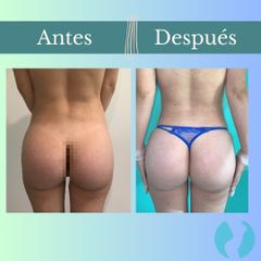 Aumento glúteos - Clinica Essenza