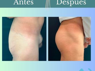 Aumento glúteos antes y después - 862052