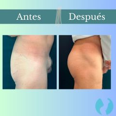 Aumento glúteos - Clinica Essenza