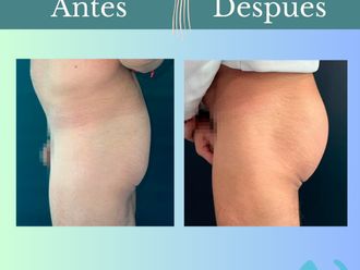 Aumento glúteos antes y después - 862053