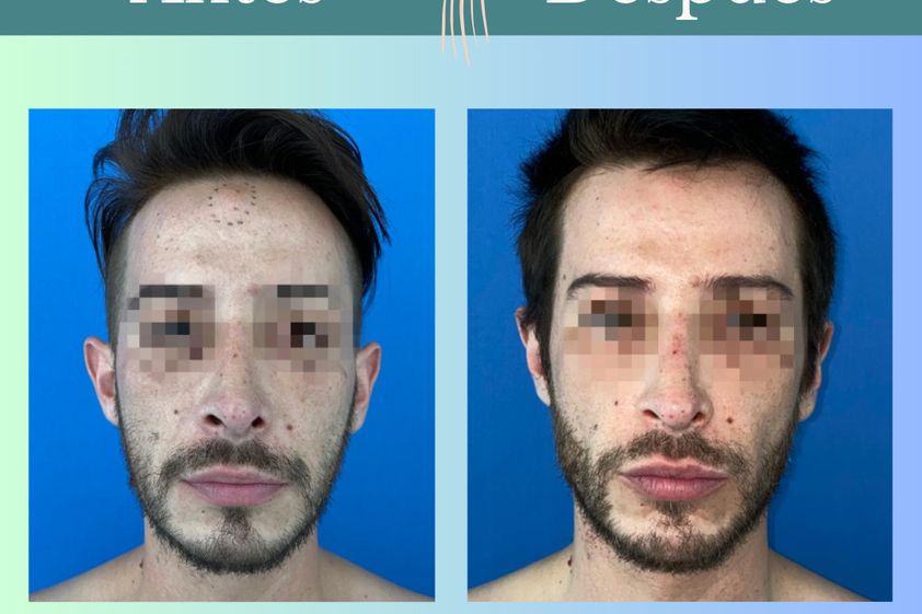 Otoplastia antes y después - 863209