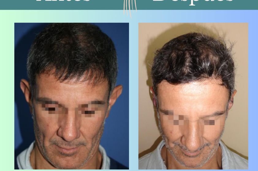 Otoplastia antes y después - 863213