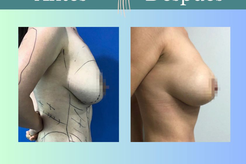 Mastopexia antes y después - 865095