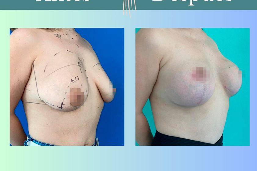 Mastopexia antes y después - 865098