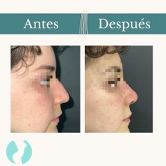 Rinoplastia - Dr. Vicente Sánchez Liberona