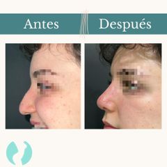 Rinoplastia - Dr. Vicente Sánchez Liberona