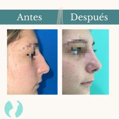 Rinoplastia - Dr. Vicente Sánchez Liberona