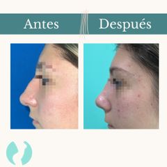 Rinoplastia - Dr. Vicente Sánchez Liberona