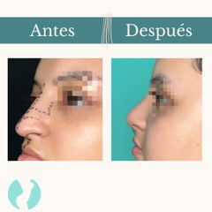 Rinoplastia - Dr. Vicente Sánchez Liberona