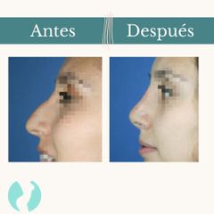 Rinoplastia - Dr. Vicente Sánchez Liberona