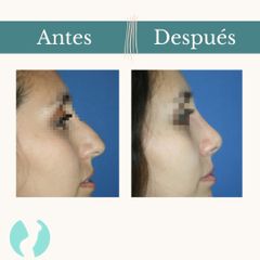 Rinoplastia - Dr. Vicente Sánchez Liberona