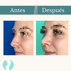 Rinoplastia - Dr. Vicente Sánchez Liberona