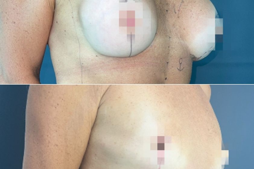 Mastopexia antes y después - 867217