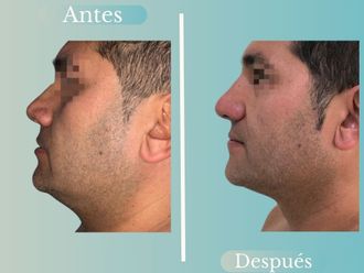 Lipopapada antes y después - 868787