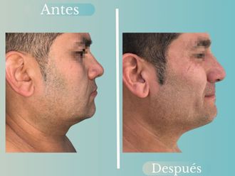 Lipopapada antes y después - 868788