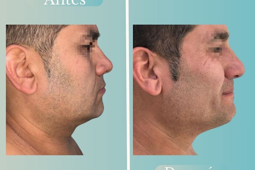 Lipopapada antes y después - 868788
