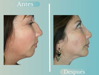 Lipopapada antes y después - 868789