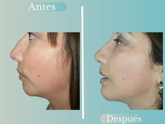 Lipopapada antes y después - 868790