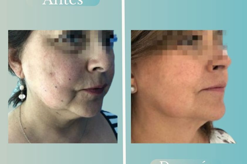 Lipopapada antes y después - 868792