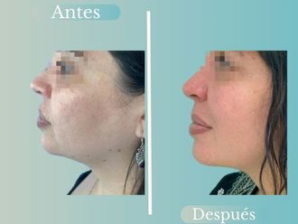 Lipopapada antes y después - 868793