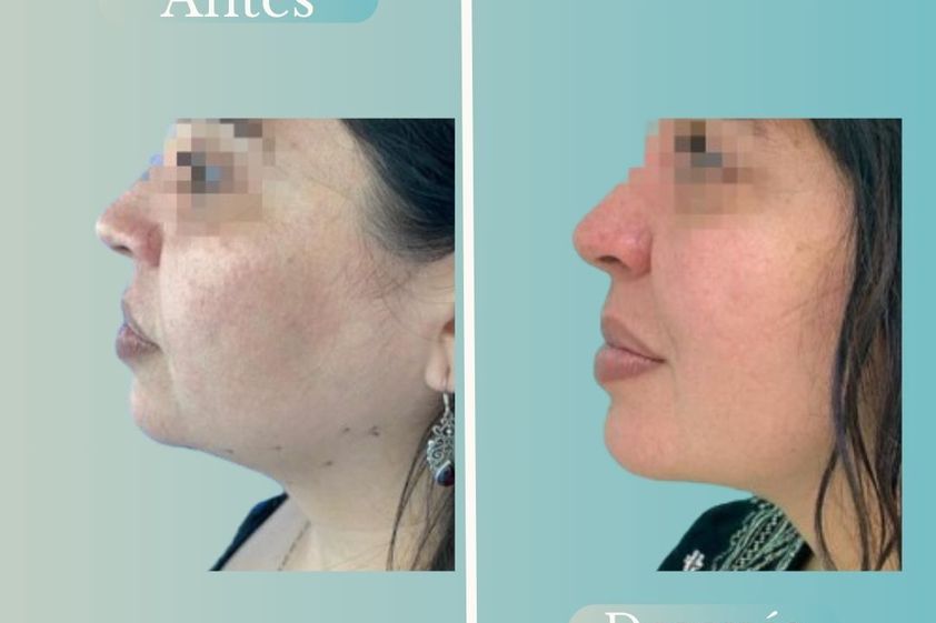 Lipopapada antes y después - 868793