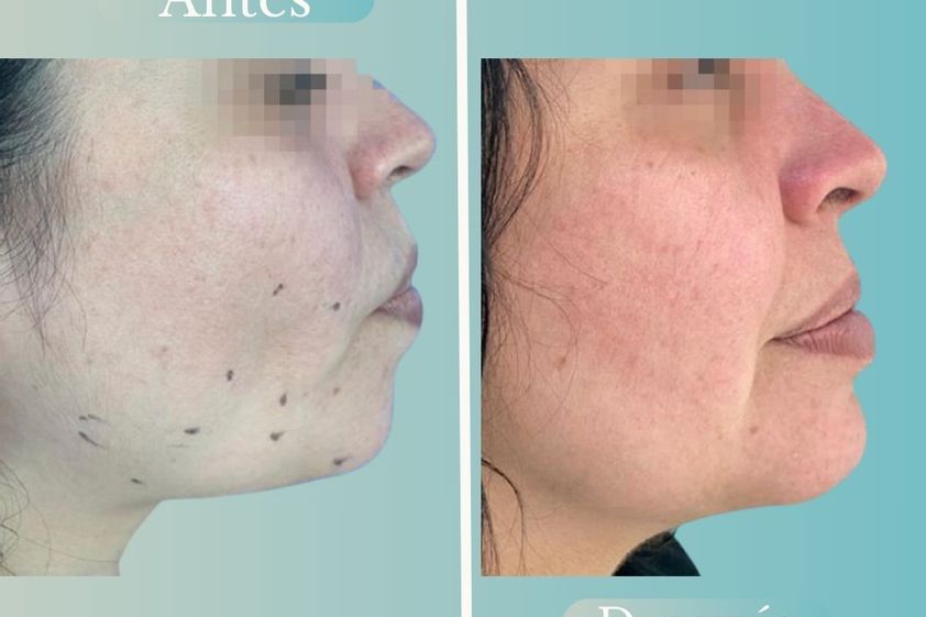 Lipopapada antes y después - 868794
