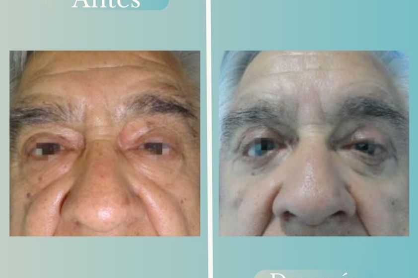 Blefaroplastía antes y después - 868801