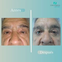 Blefaroplastia - Dr. Vicente Sanchez Liberona