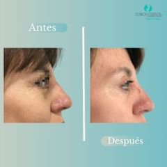 Blefaroplastia - Dr. Vicente Sanchez Liberona