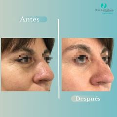 Blefaroplastia - Dr. Vicente Sanchez Liberona