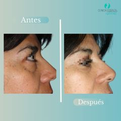 Blefaroplastia - Dr. Vicente Sanchez Liberona