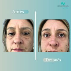 Blefaroplastia - Dr. Vicente Sanchez Liberona