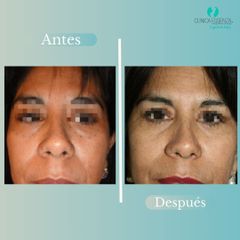 Blefaroplastia - Dr. Vicente Sanchez Liberona