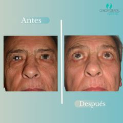 Blefaroplastia - Dr. Vicente Sanchez Liberona