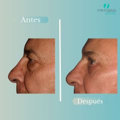 Blefaroplastia - Dr. Vicente Sanchez Liberona