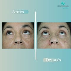 Blefaroplastia - Dr. Vicente Sanchez Liberona